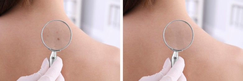 Image of Collage with photos of patient's back before and after mole removing procedure, closeup. Dermatologist looking at skin through magnifying glass