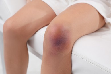 Photo of Little child with bruised knee sitting on examination table in hospital, closeup