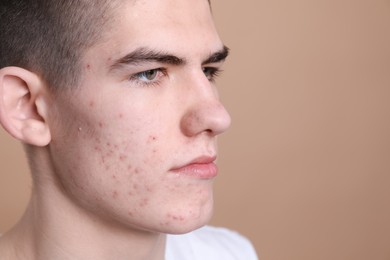 Young man with acne problem on beige background, closeup. Space for text