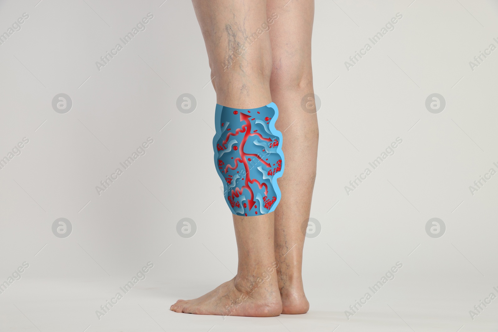 Image of Closeup view of woman with varicose veins on white background. Illustration of damaged vein, longitudinal section