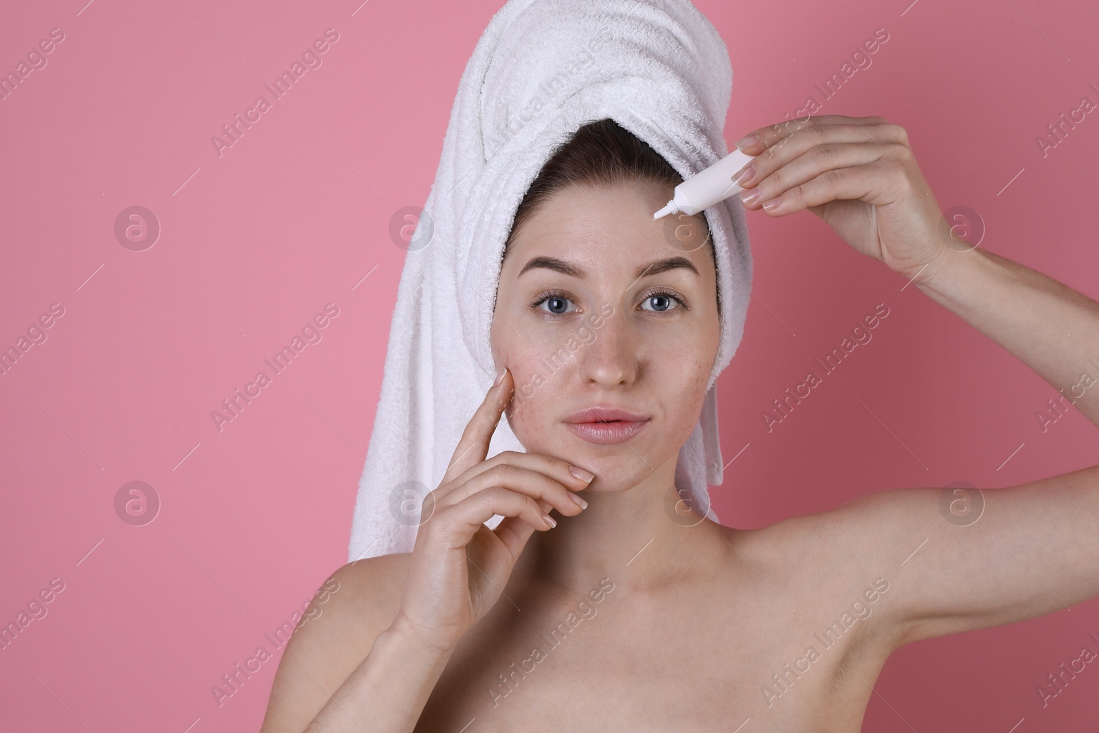 Photo of Young woman with acne problem applying cosmetic product onto her skin on pink background