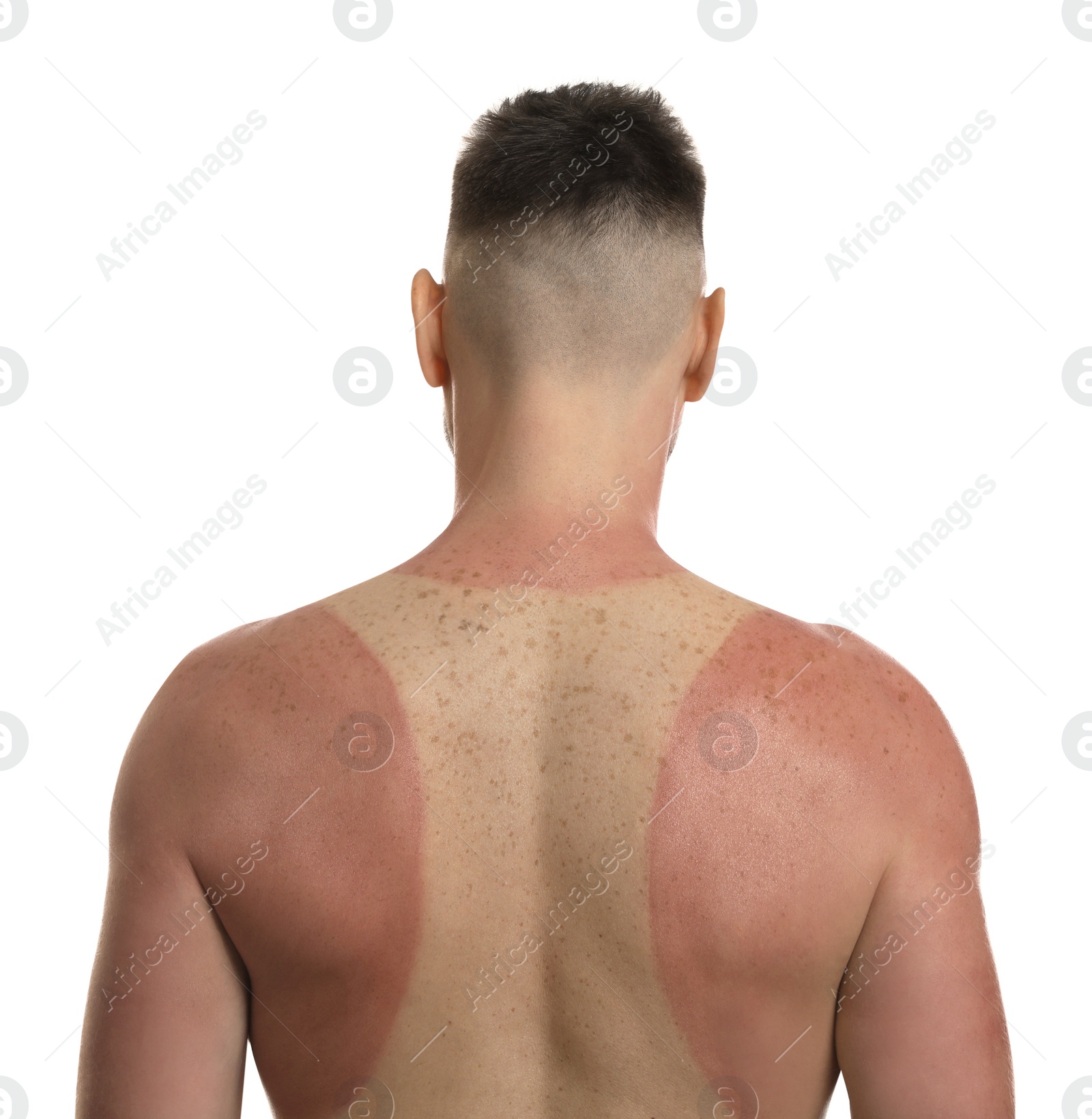 Photo of Man with sunburned skin on white background, back view