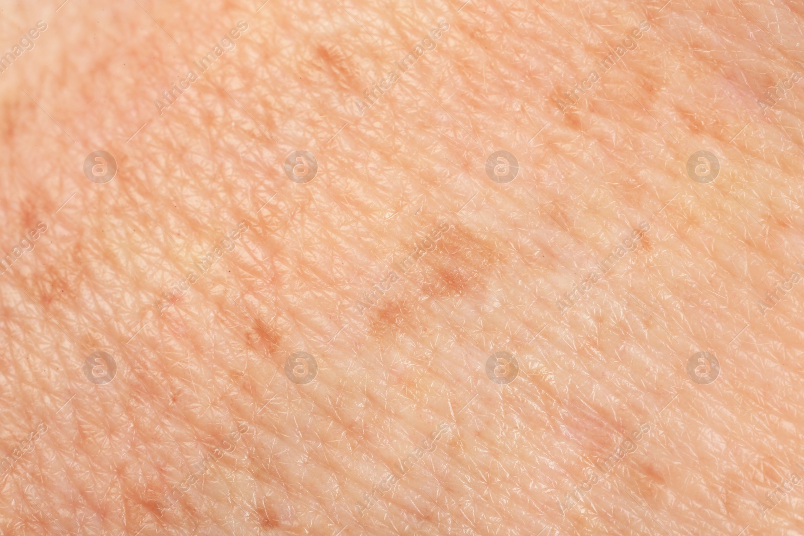 Photo of Texture of skin with pigmentation as background, macro view