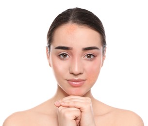 Image of Young woman with dry skin on white background