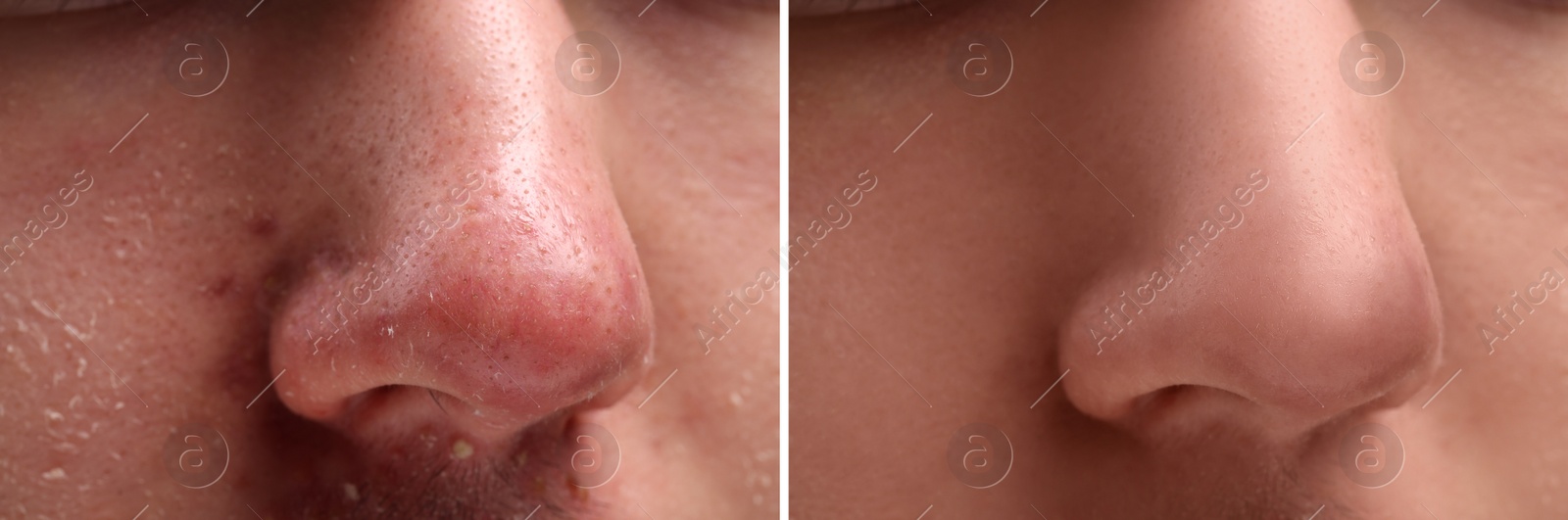 Image of Photos of man before and after acne treatment, closeup. Collage showing affected and healthy skin