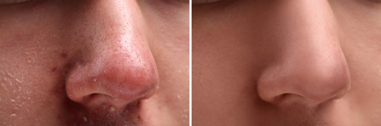 Image of Photos of man before and after acne treatment, closeup. Collage showing affected and healthy skin