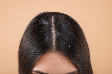 Photo of Woman with dandruff in her dark hair on beige background, closeup