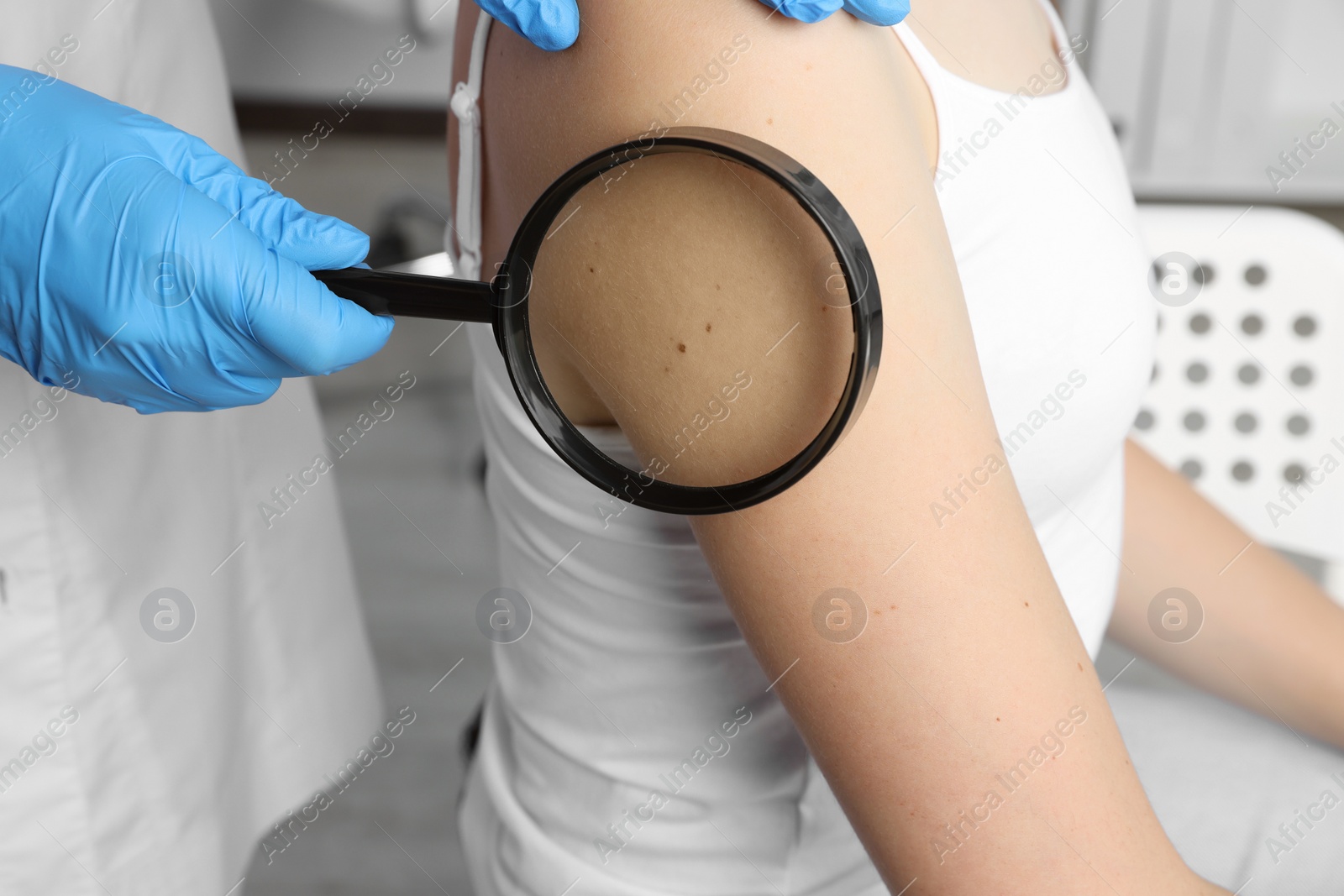 Photo of Dermatologist examining patient's birthmark with magnifying glass in clinic, closeup