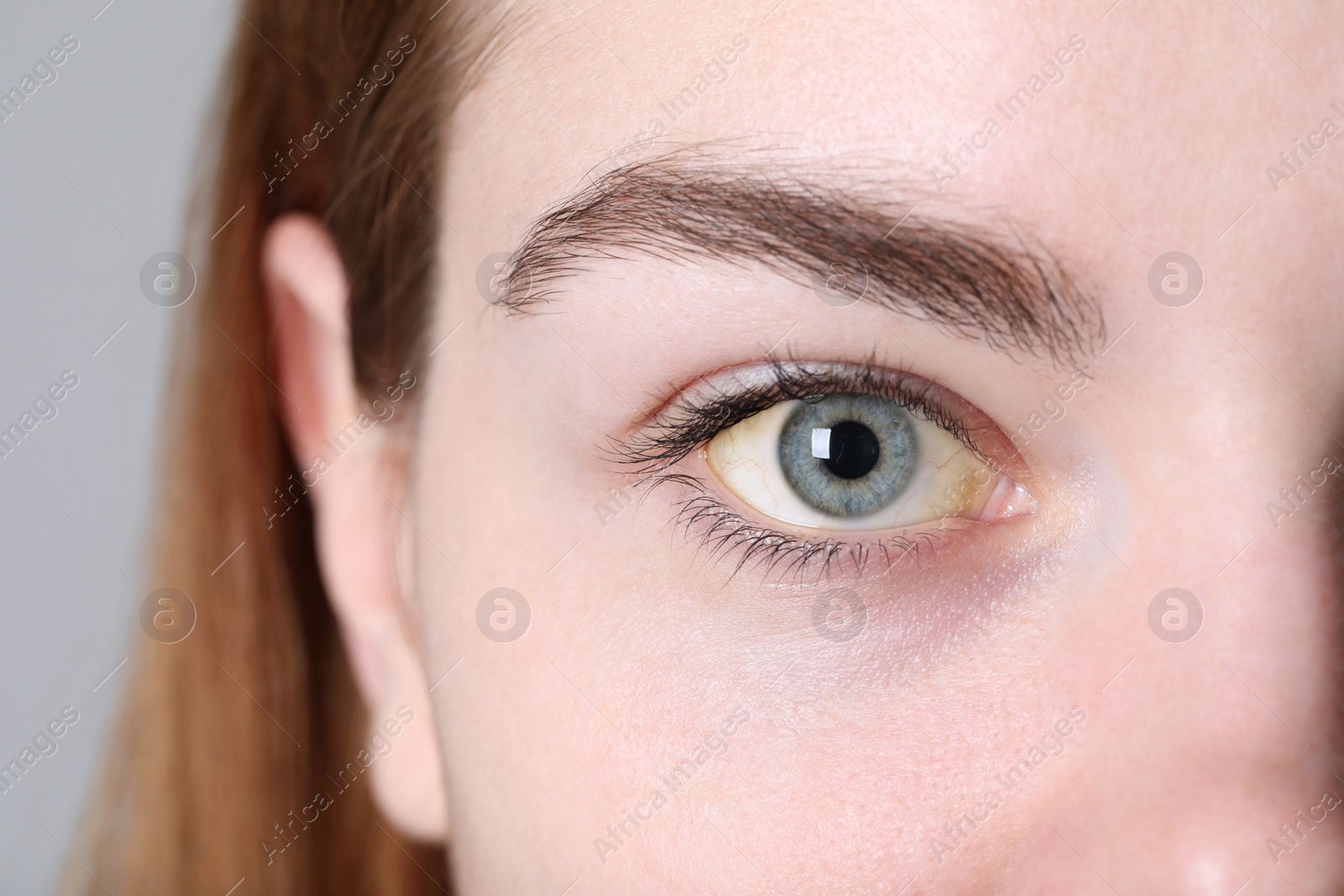 Photo of Woman with yellow eyes on light background, closeup. Symptom of hepatitis