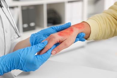 Photo of Doctor examining patient's burned hand indoors, closeup