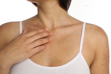 Photo of Closeup view of woman's body with birthmarks on white background