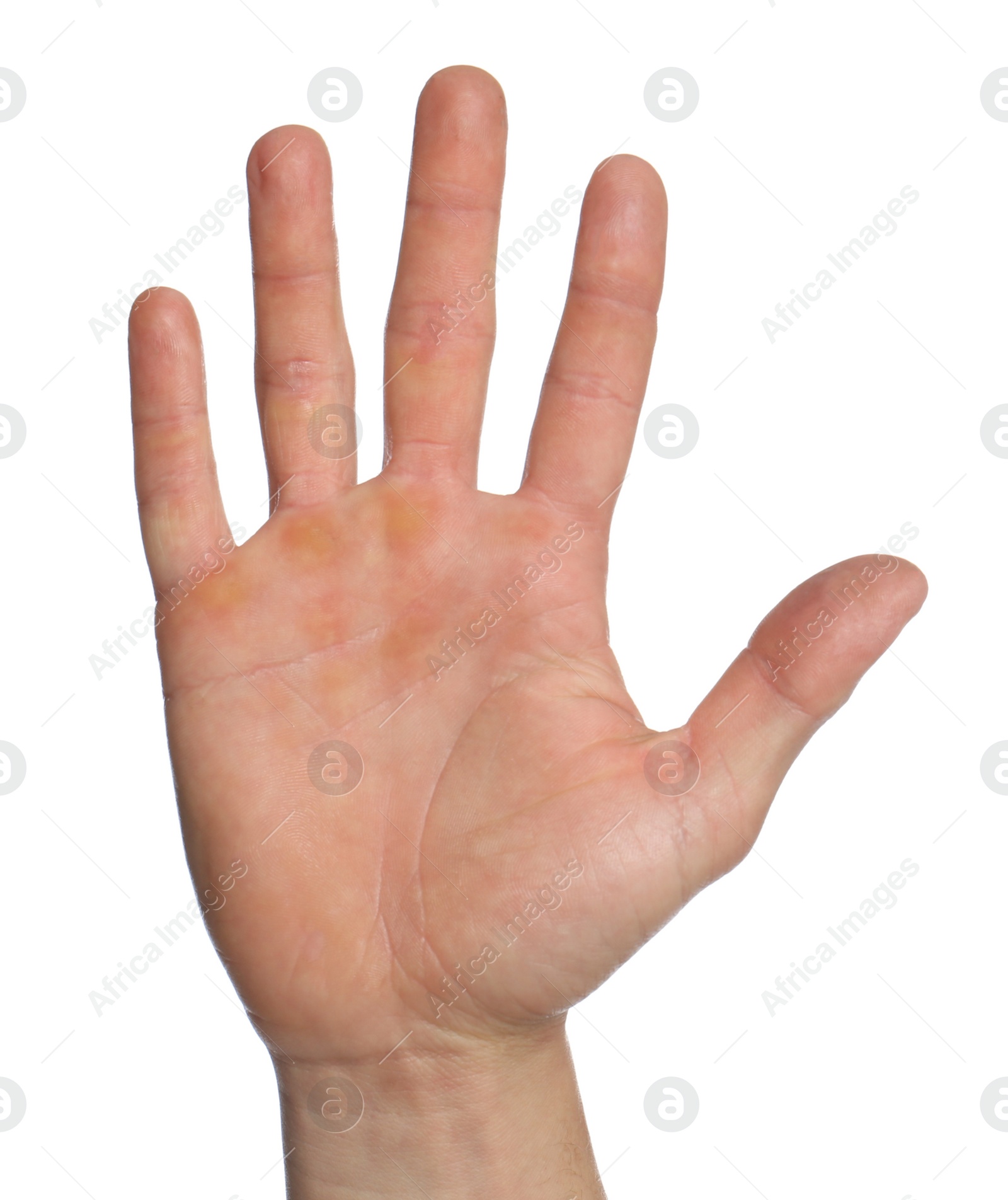 Photo of Man suffering from calluses on hand against white background, closeup