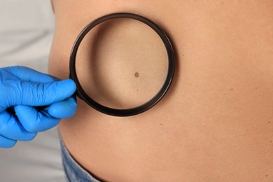 Photo of Dermatologist examining patient's birthmark with magnifying glass, closeup