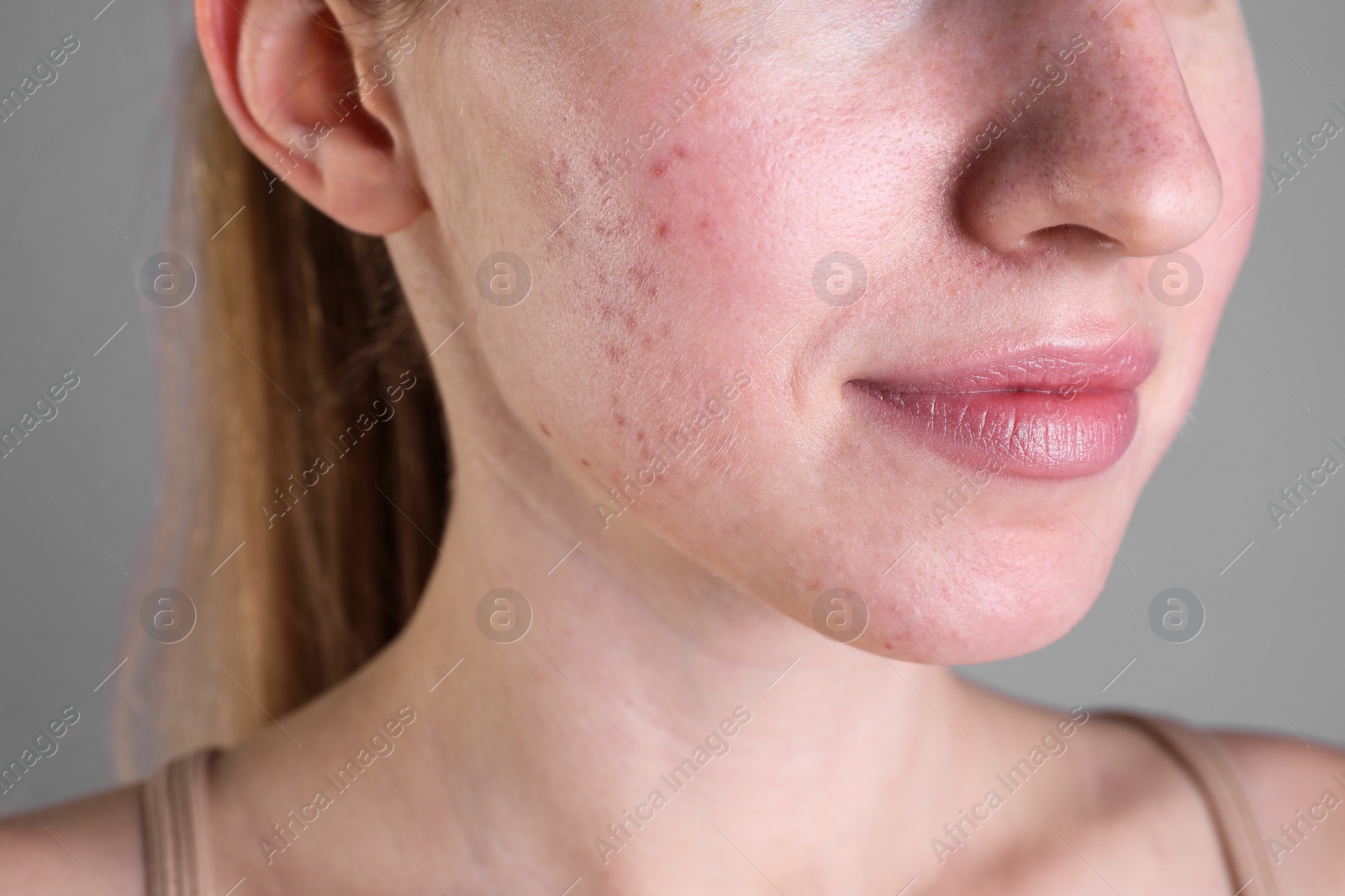 Photo of Young woman with acne problem on light grey background, closeup