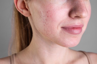 Young woman with acne problem on light grey background, closeup