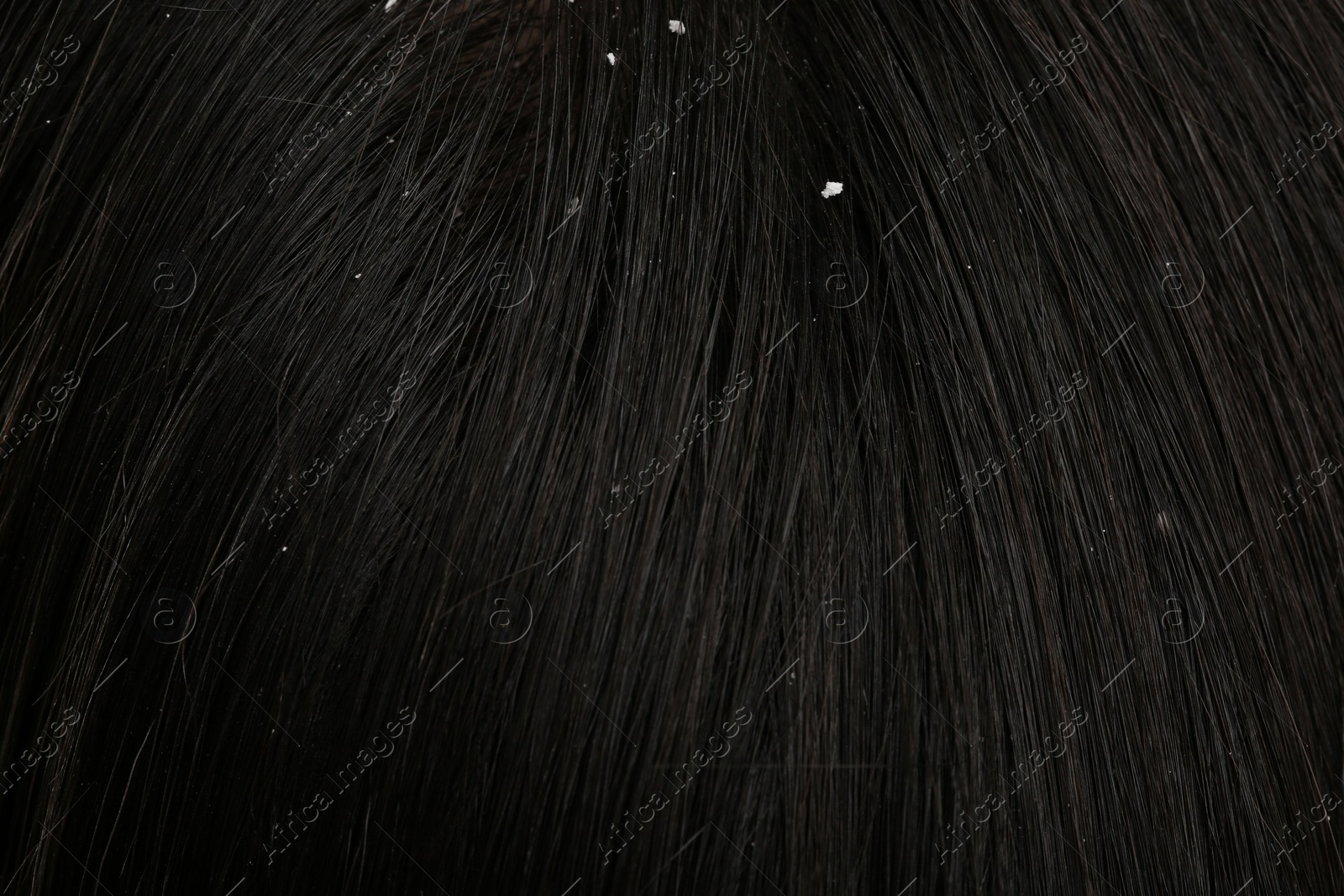 Photo of Woman with dandruff in her dark hair, closeup view