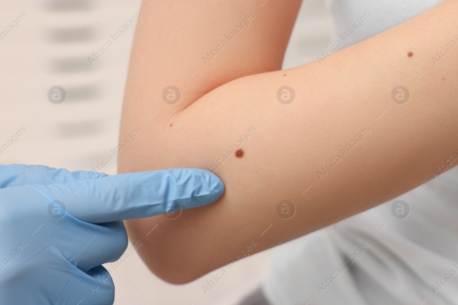 Photo of Dermatologist in rubber glove examining patient's birthmark on blurred background, closeup