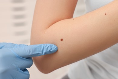 Photo of Dermatologist in rubber glove examining patient's birthmark on blurred background, closeup