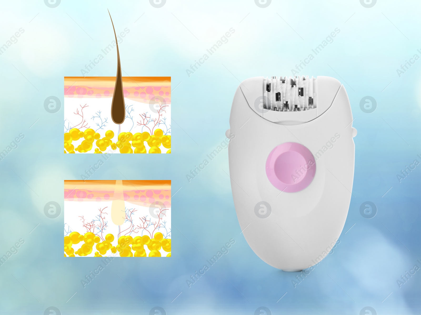 Image of Epilation procedure. Modern appliance and illustrations of hair follicle on light blue background