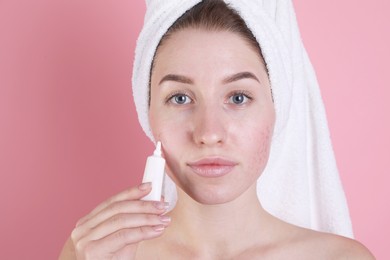 Young woman with acne problem applying cosmetic product onto her skin on pink background