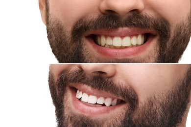 Image of Man showing teeth before and after whitening on white background, collage