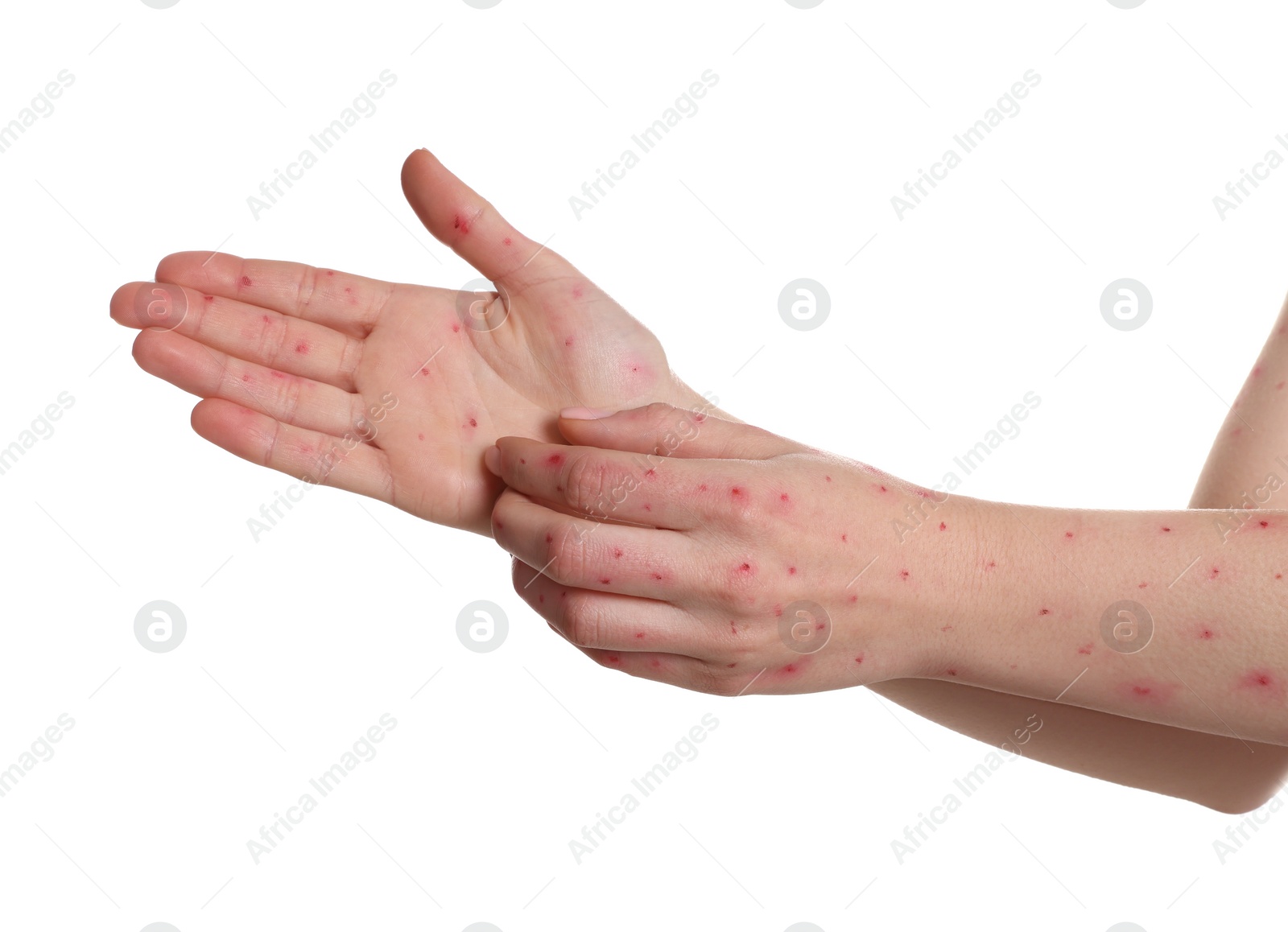 Photo of Woman with rash suffering from monkeypox virus on white background, closeup