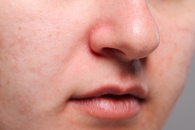 Photo of Closeup view of woman with comedones on her nose