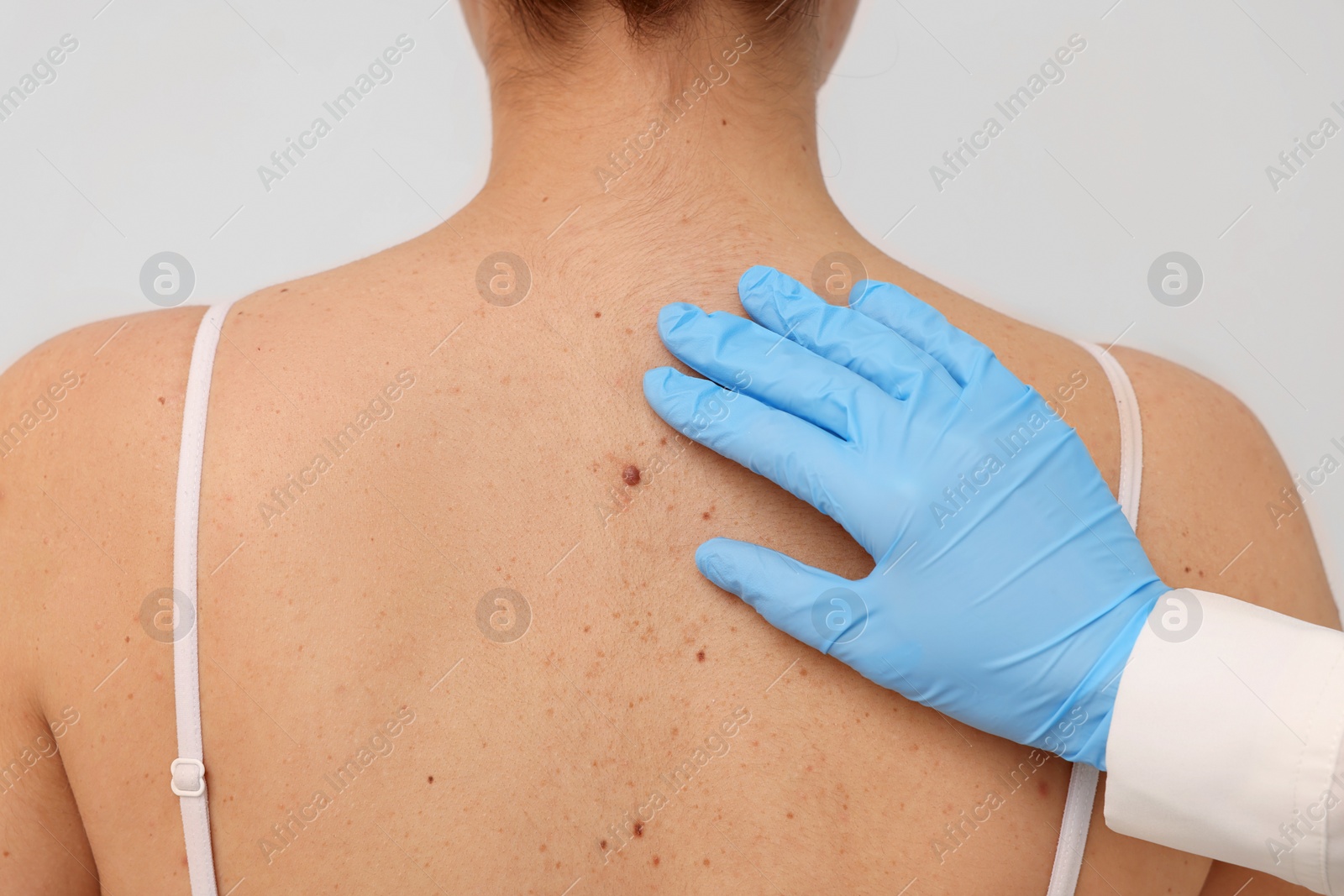 Photo of Dermatologist examining patient's birthmark on beige background, closeup
