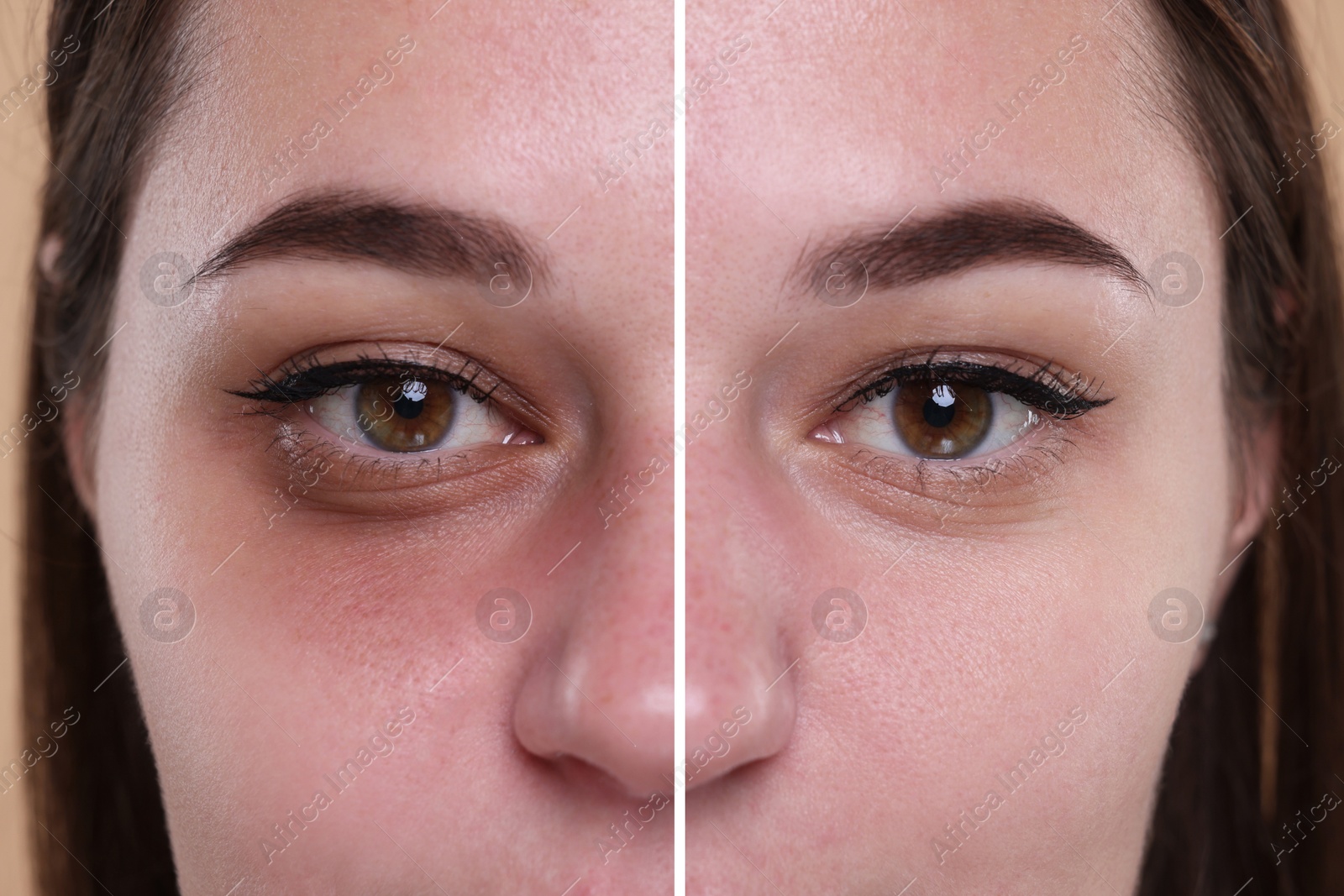 Image of Collage with photos of woman with dark circle under eye before and after treatment, closeup