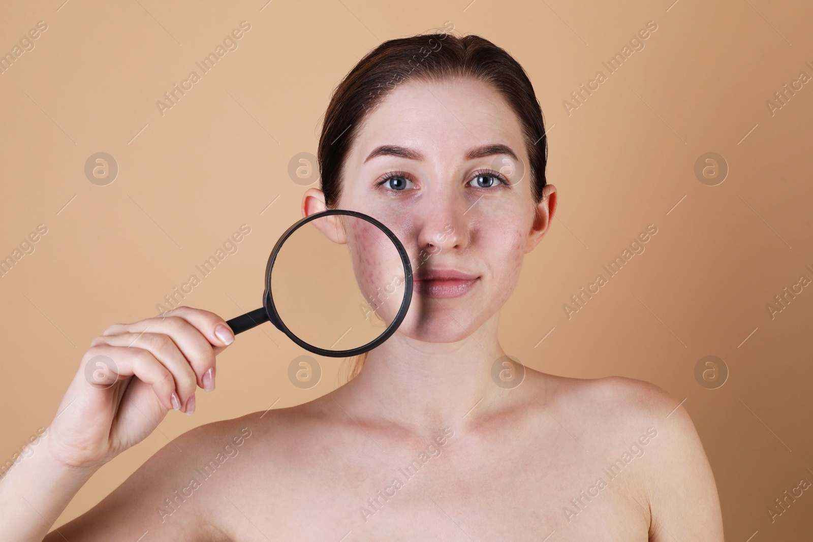 Photo of Young woman with acne problem holding magnifying glass near her skin on beige background