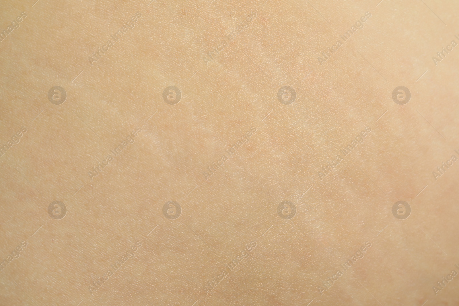 Photo of Texture of human skin with birthmark and stretch marks, closeup view
