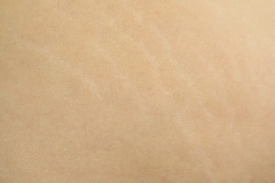 Photo of Texture of human skin with birthmark and stretch marks, closeup view