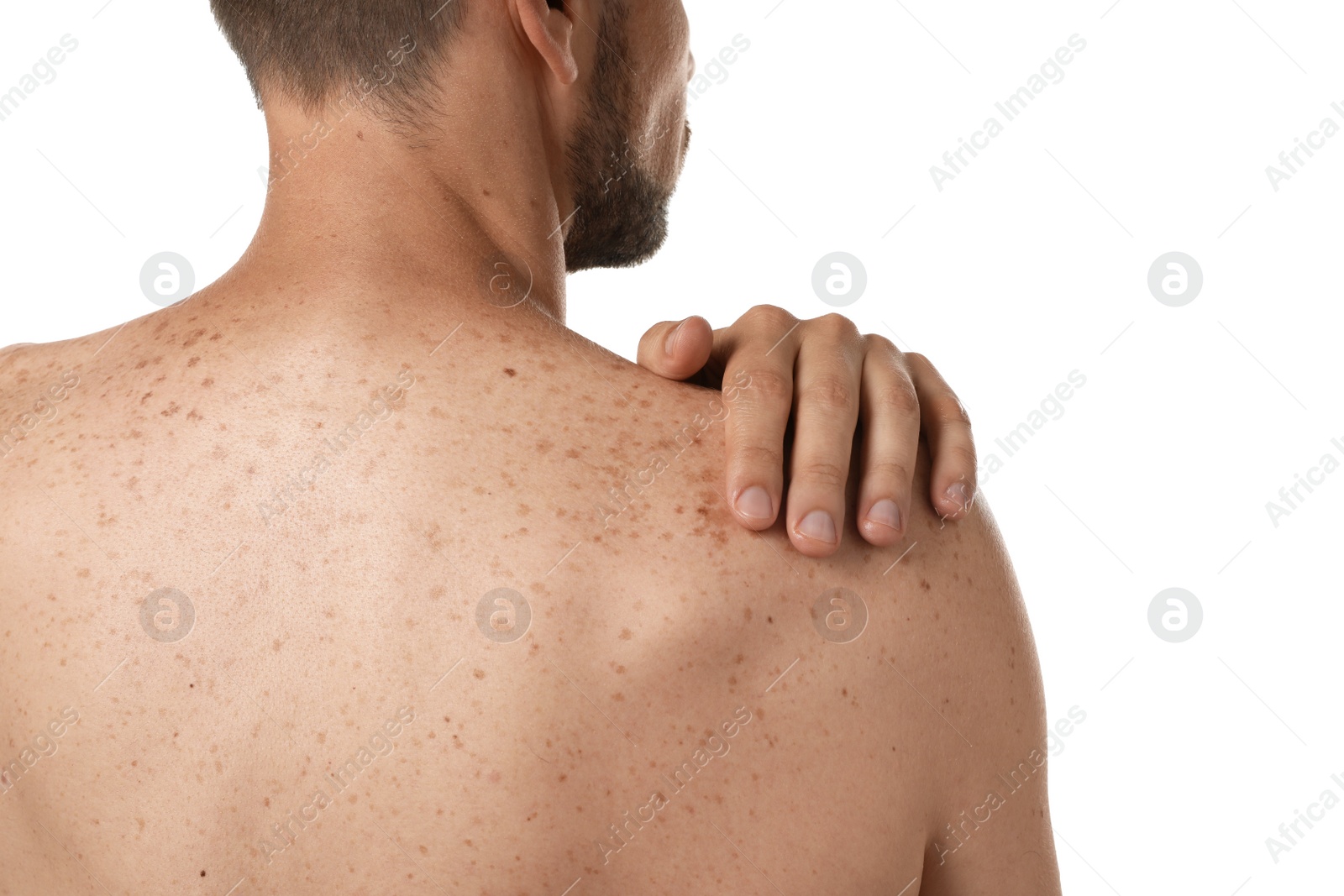 Photo of Closeup of man`s body with birthmarks on white background, back view