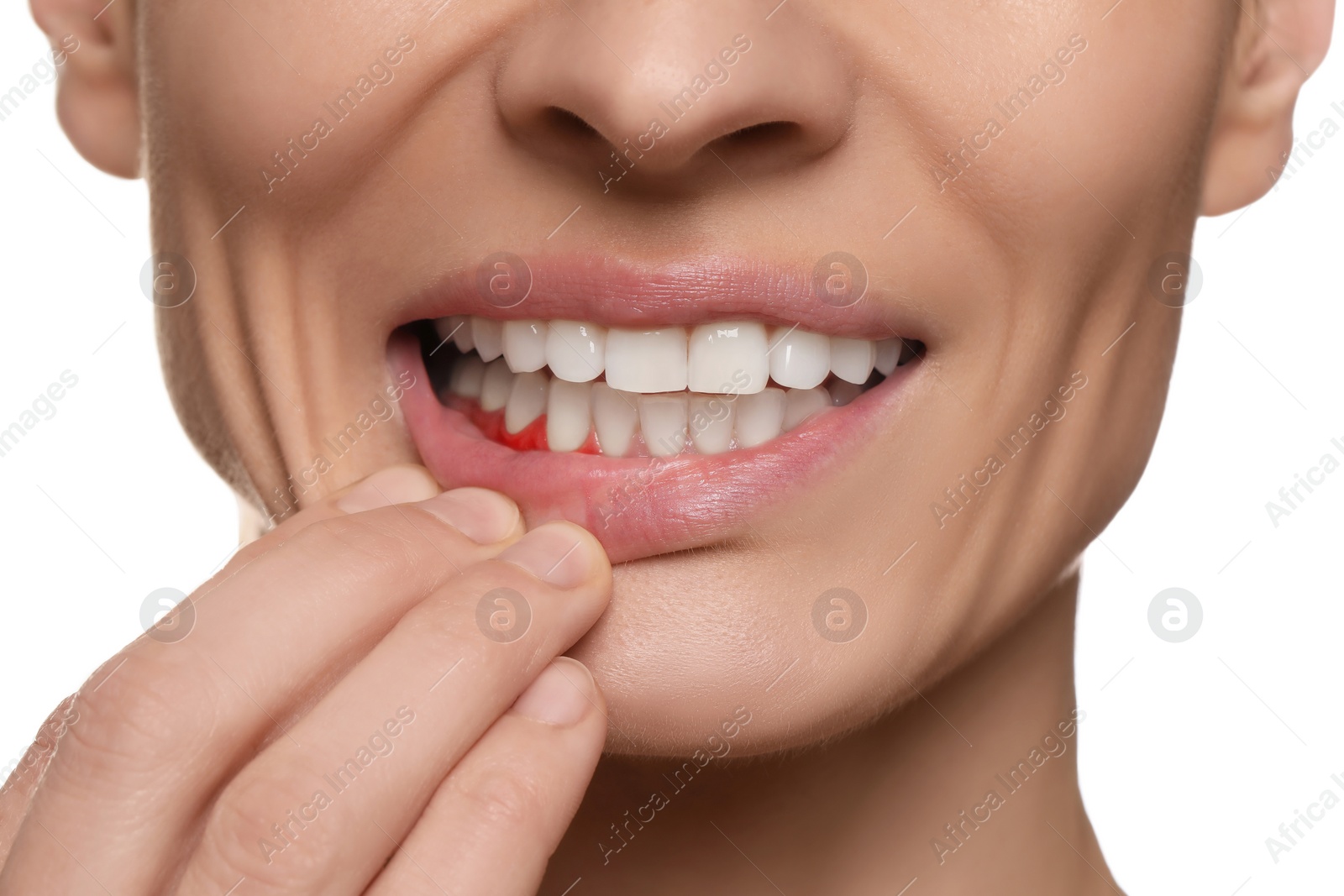 Image of Woman showing inflamed gum on white background, closeup