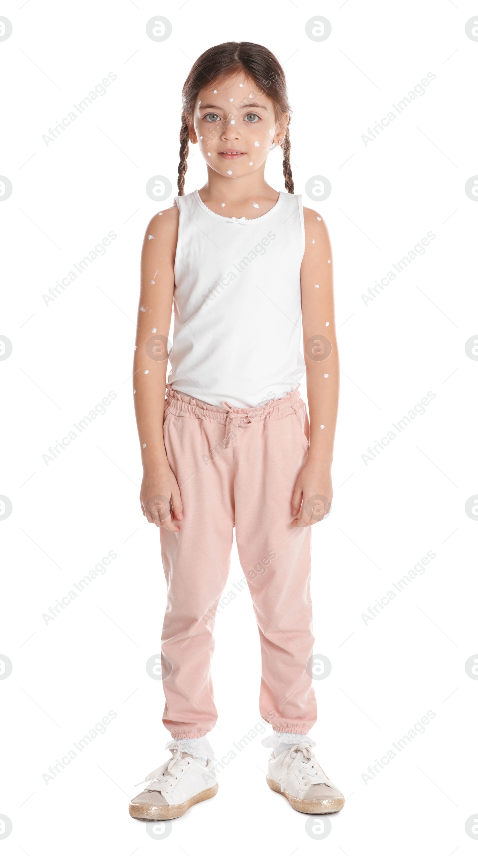 Photo of Little girl with chickenpox on white background