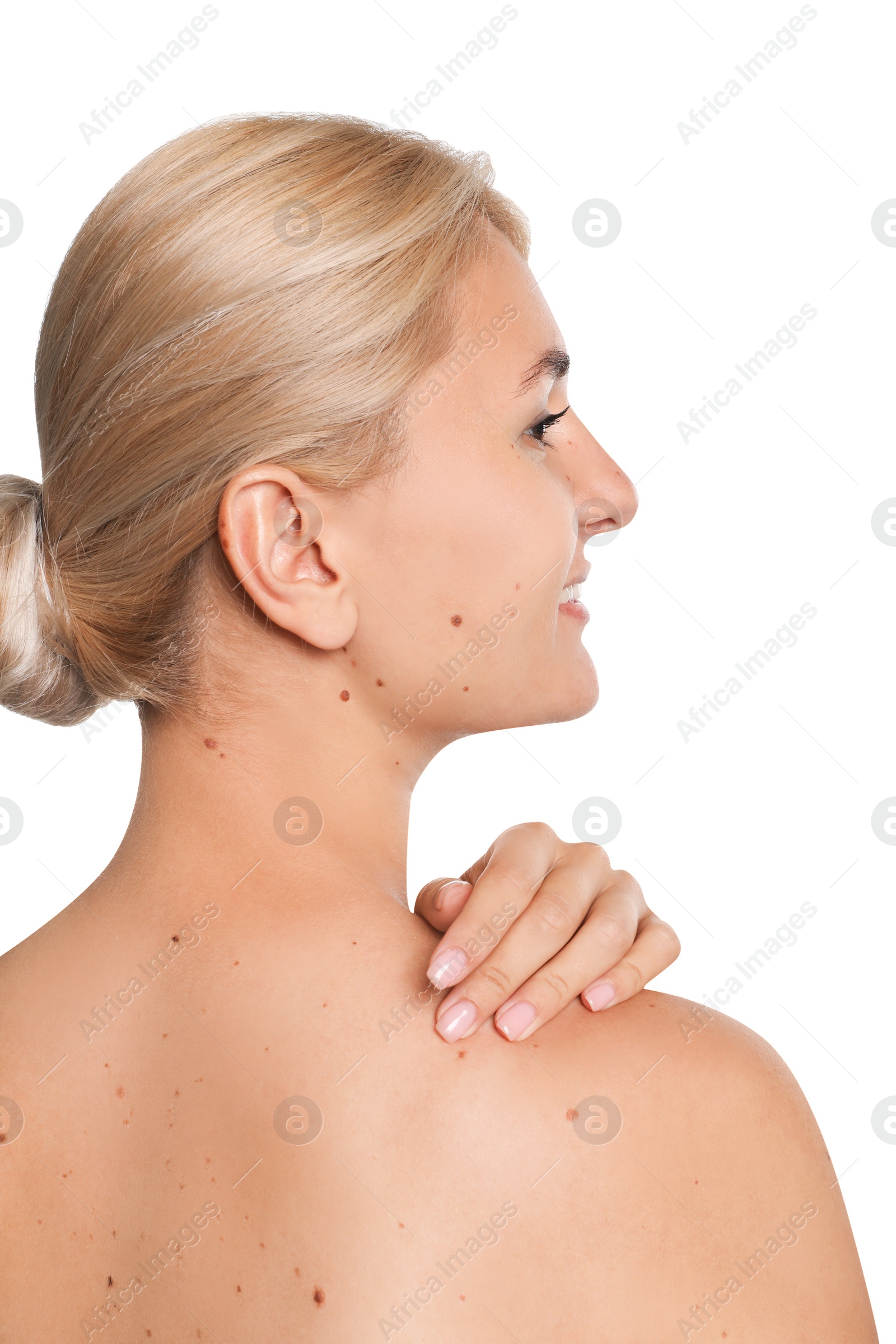 Photo of Beautiful young woman with birthmarks on white background