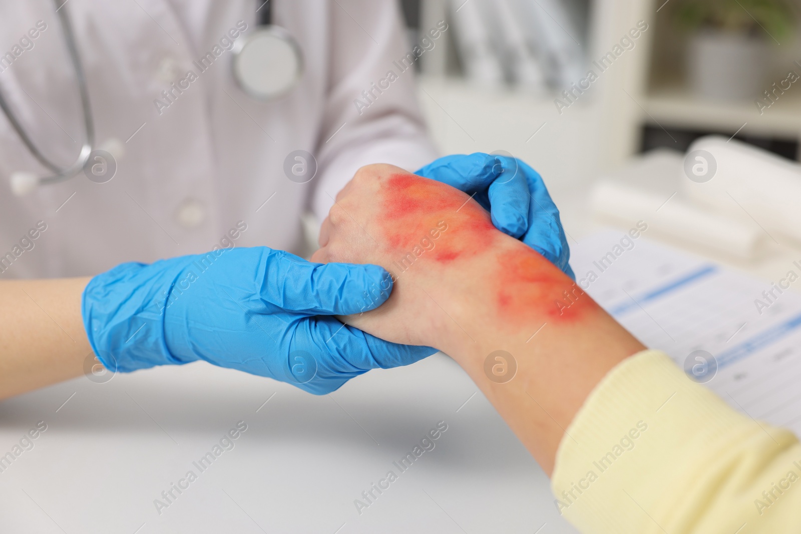 Photo of Doctor examining patient's burned hand in hospital, closeup