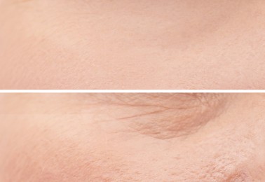 Image of Collage with photos of dry and moisturized skin texture