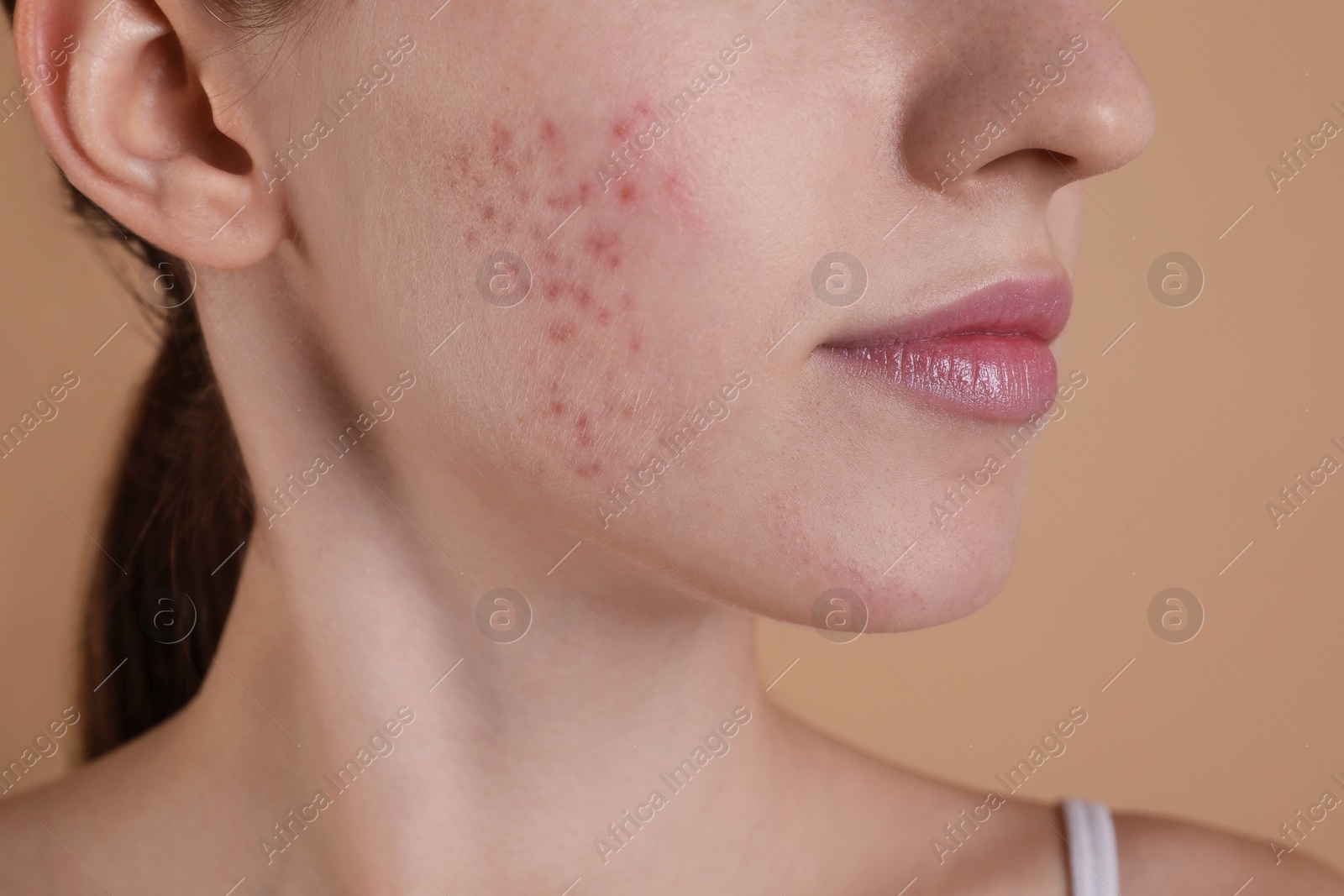 Photo of Young woman with acne problem on beige background, closeup