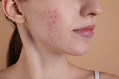 Young woman with acne problem on beige background, closeup
