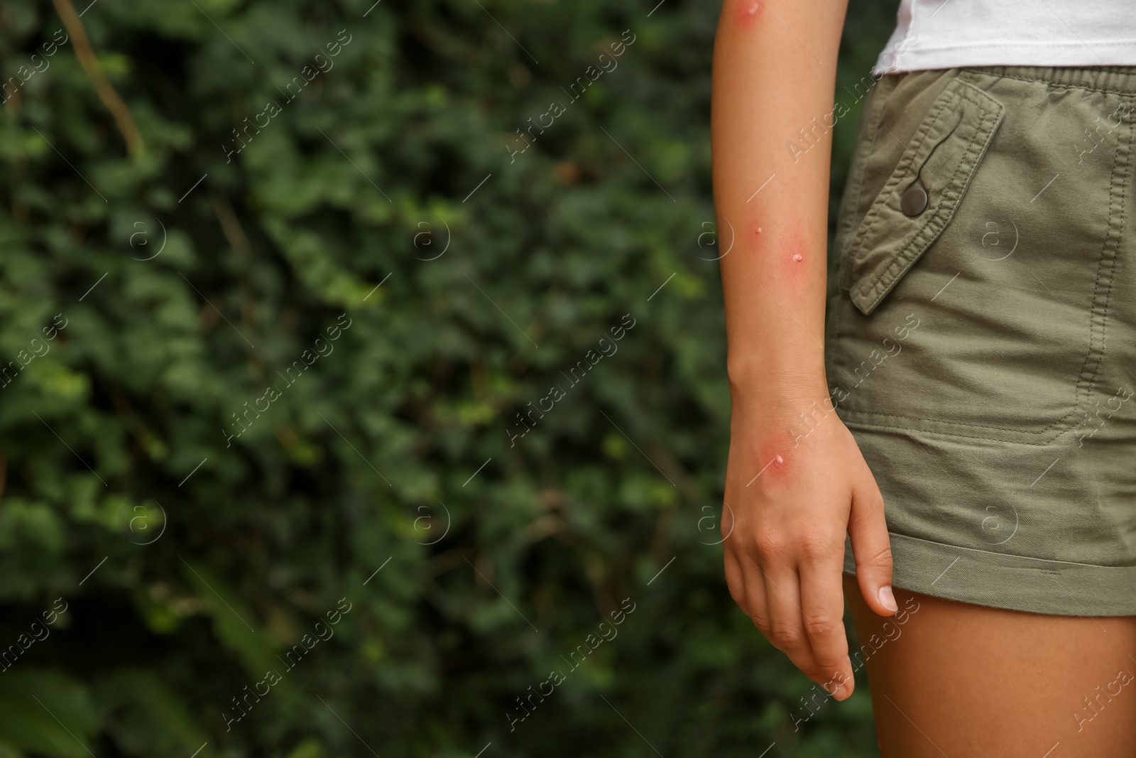 Photo of Woman with insect bites on arm in park, closeup. Space for text