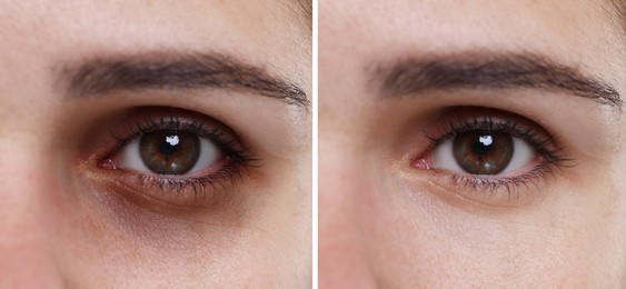 Image of Collage with photos of woman with dark circle under eye before and after treatment, closeup