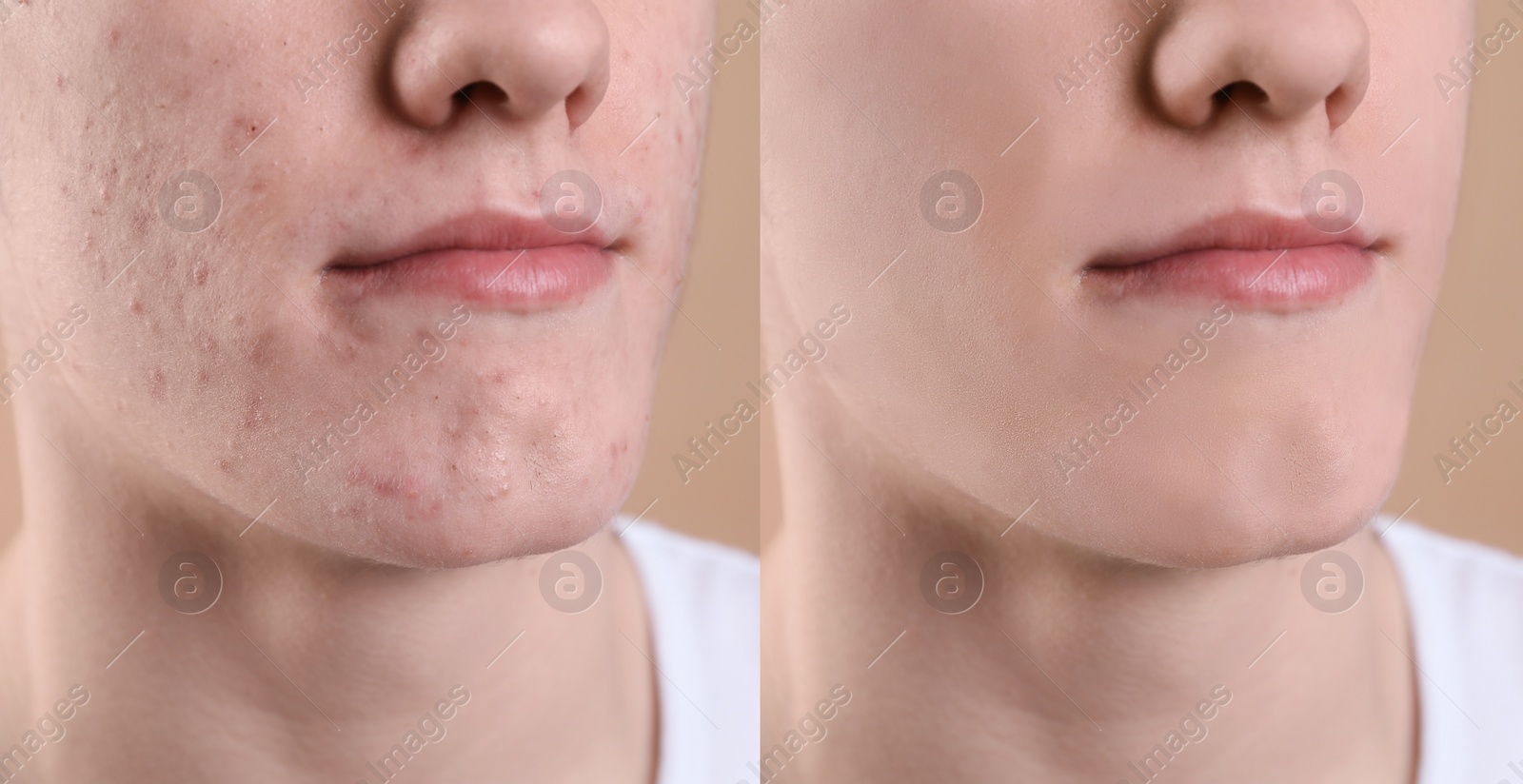 Image of Acne problem. Young man before and after treatment on beige background, closeup. Collage of photos