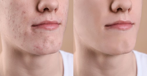 Acne problem. Young man before and after treatment on beige background, closeup. Collage of photos