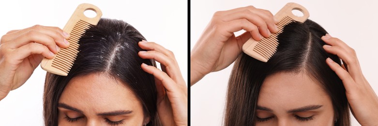 Image of Woman showing hair before and after dandruff treatment on white background, collage