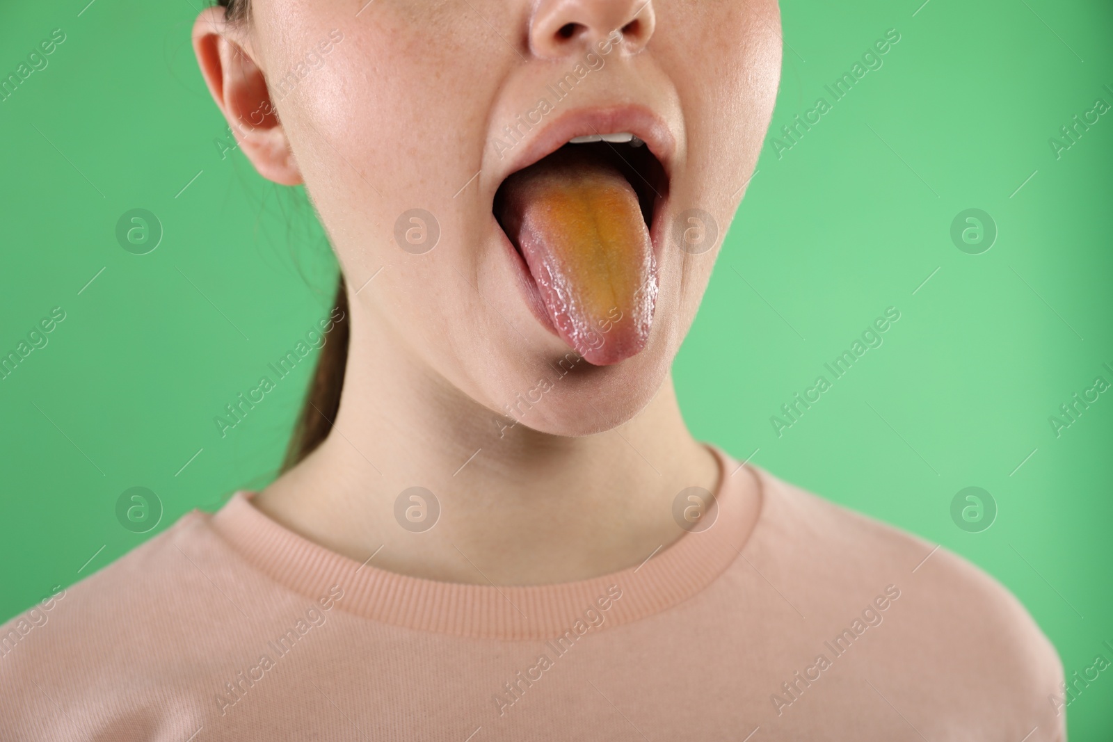 Photo of Gastrointestinal diseases. Woman showing her yellow tongue on green background, closeup