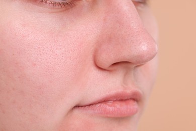 Photo of Closeup view of woman with blackheads on her nose against beige background