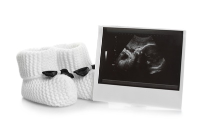 Photo of Ultrasound photo and baby shoes on white background. Concept of pregnancy