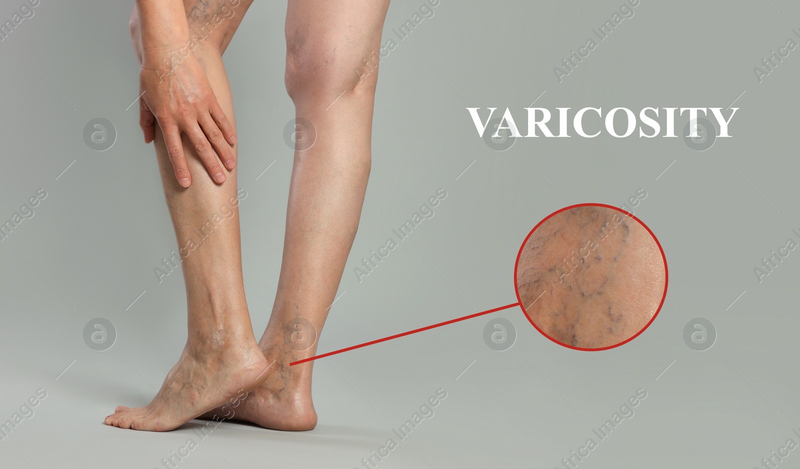 Image of Woman suffering from varicose veins on light grey background, closeup. Magnified skin surface showing affected area