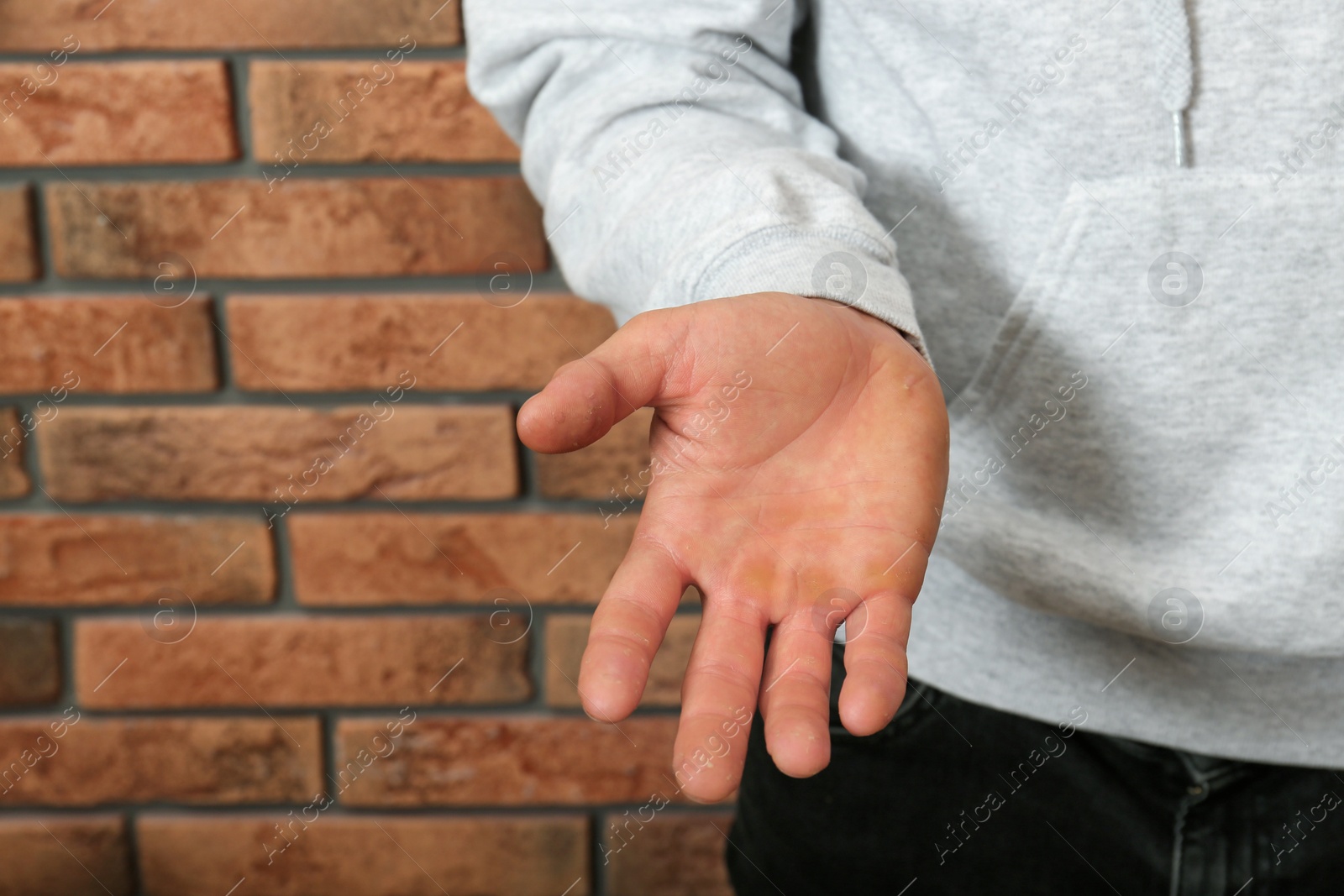 Photo of Man suffering from calluses on hand near brick wall, closeup